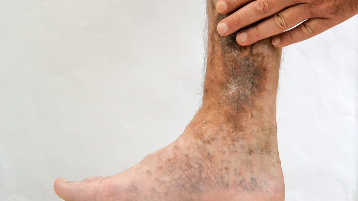 Illness of the human skin. Person s hands touch scars, ulcers, peeling and age spots, possibly after varicose veins or thrombosis on his leg.